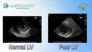 057 Poor Global LV Function TEE KAMC