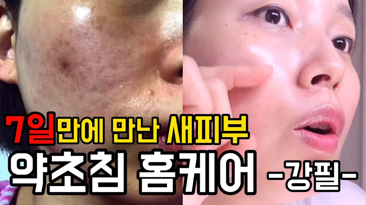 피부과에서도 안 알려주는‼️약초침 5년 경력의 숨은 꿀팁 대방출🍯 | 약초침 홈케어 강필 | 롤링부터 후관리까지 싹 다 알려드림 | 배유진 YUJIN B