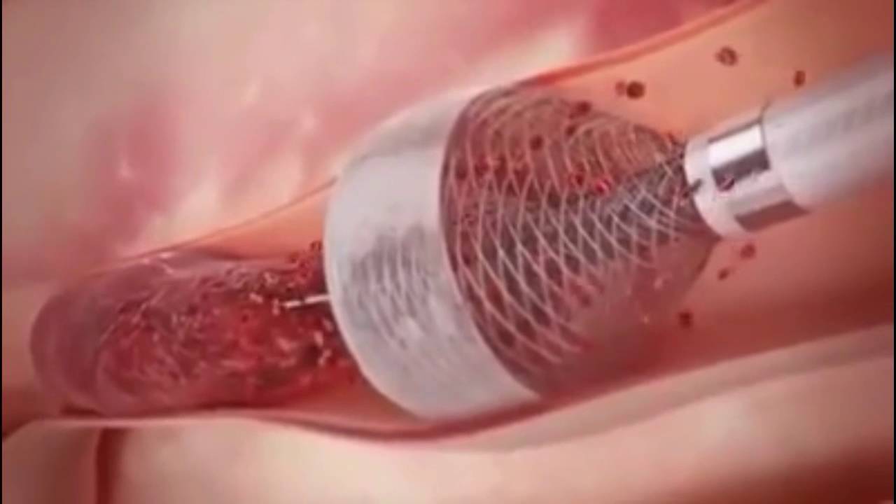 Clot Removal Technology YouTube