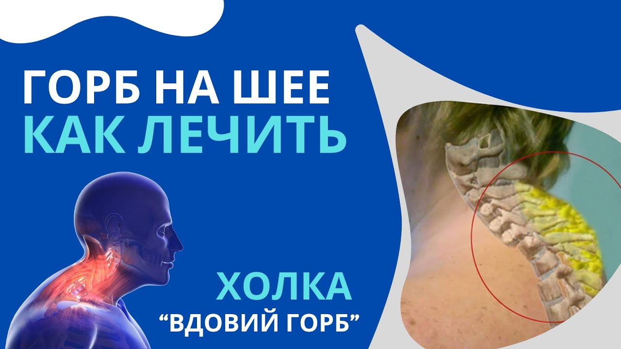 Горб на шее. «Вдовий горб». Причины и лечение. Методы безопасного избавления от холки на шее.