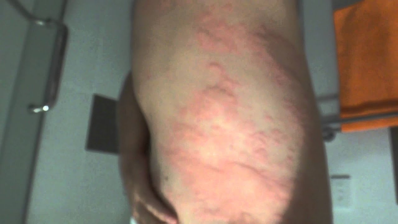 can clopidogrel cause skin rash