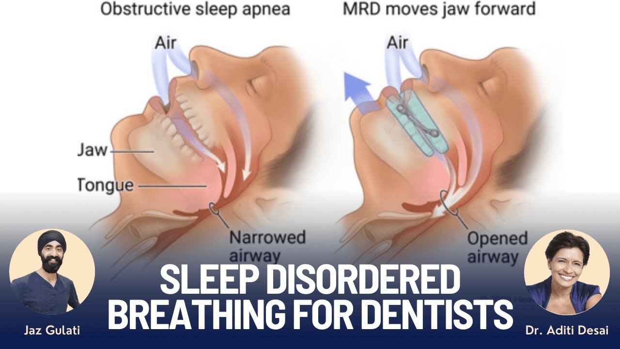 Sleep Disordered Breathing and Dentistry - PDP139