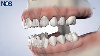 PostOp Instructions: Allon4® at Naperville Oral Surgery & Dental Implants