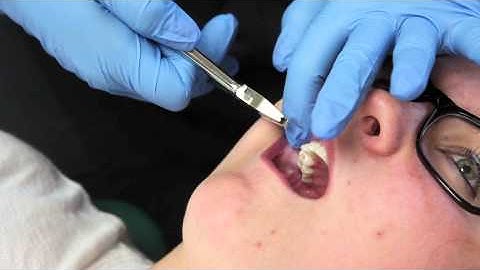 Clarity Advanced Bracket Removal-It