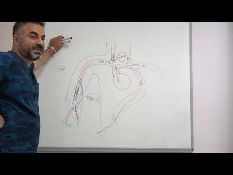 Koldaki damar tıkanıklığı tedavisi / Şah damarı çalma sendromu - Prof. Dr. Ahmet AKGÜL