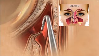 Sinus Surgery 3D Animation | Sinusitis Treatment | Sinus Operation screenshot 4