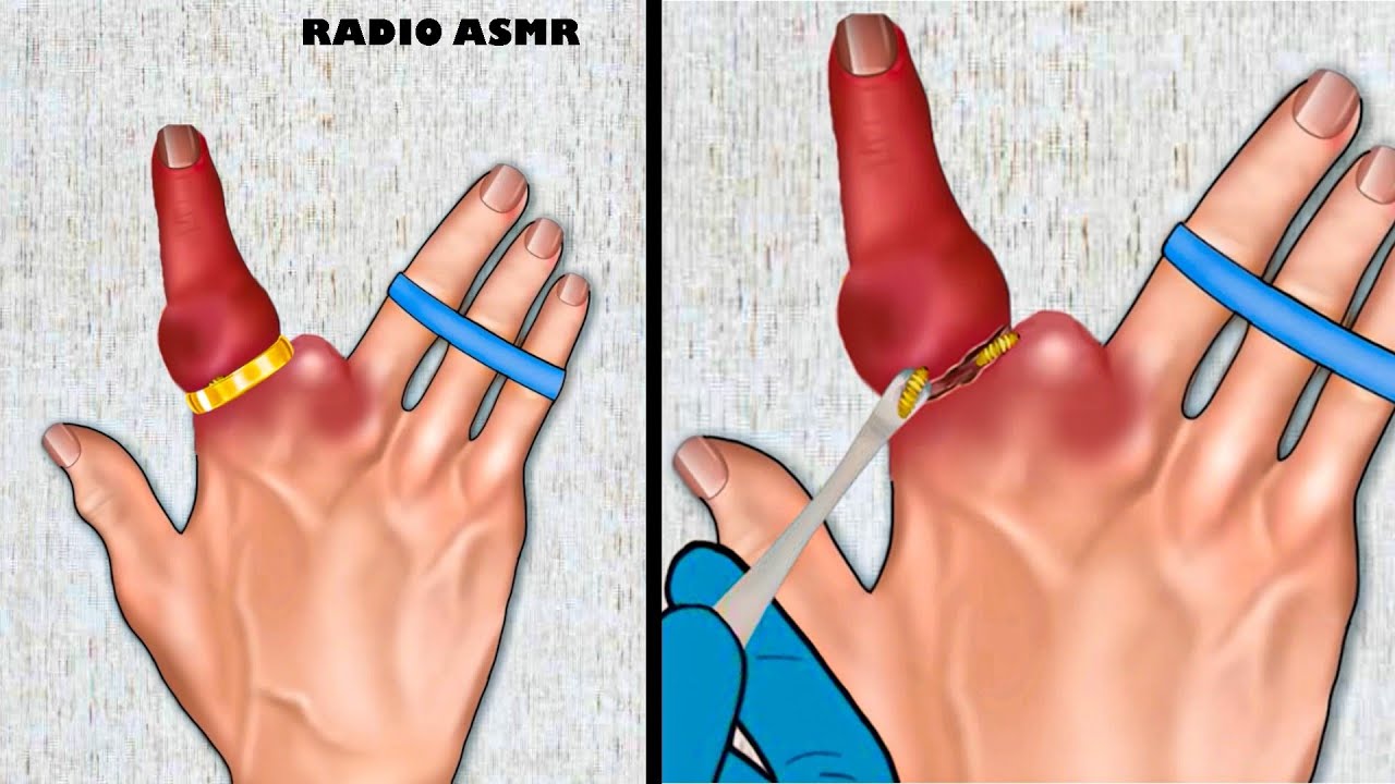 [ASMR ANIMATION] Removing Ring From the Hand / Helping Messi - YouTube