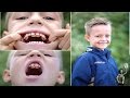 Shark boy:Meet schoolboy nicknamed 'Jaws' with TWO sets of teeth