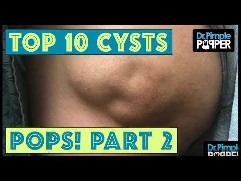 Dr Pimple Popper's Top 10 Cyst POPS Of 2017, Part 2!