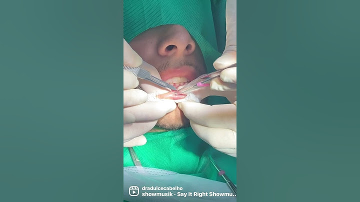 Cirurgia em lábio #estomatologista #estomatologia  Saiba mais: 11991800961