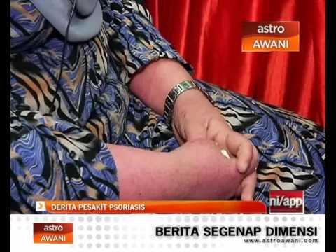 Video: Psoriasis Dan Kehamilan: Risiko Dan Rawatan