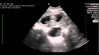 OB feedback - subchorionic hemorrhage - 4.14.2015 - LGH