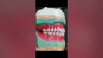 Balanced occlusion ,pre clinical teeth setting.@Dentisttobe61dentisttobe