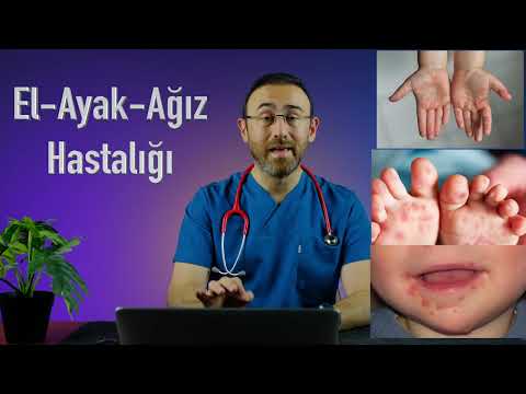 El Ayak Ağız Hastalığı Nedir? (Belirti, Korunma, Tedavi)