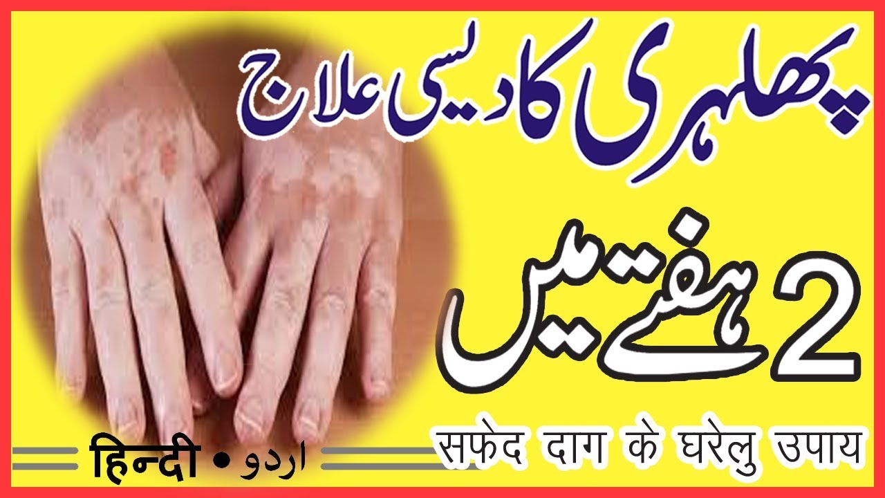 Phulbehri Treatment In Urdu | Treatment for Vitiligo at Home| by sanam video editing software free