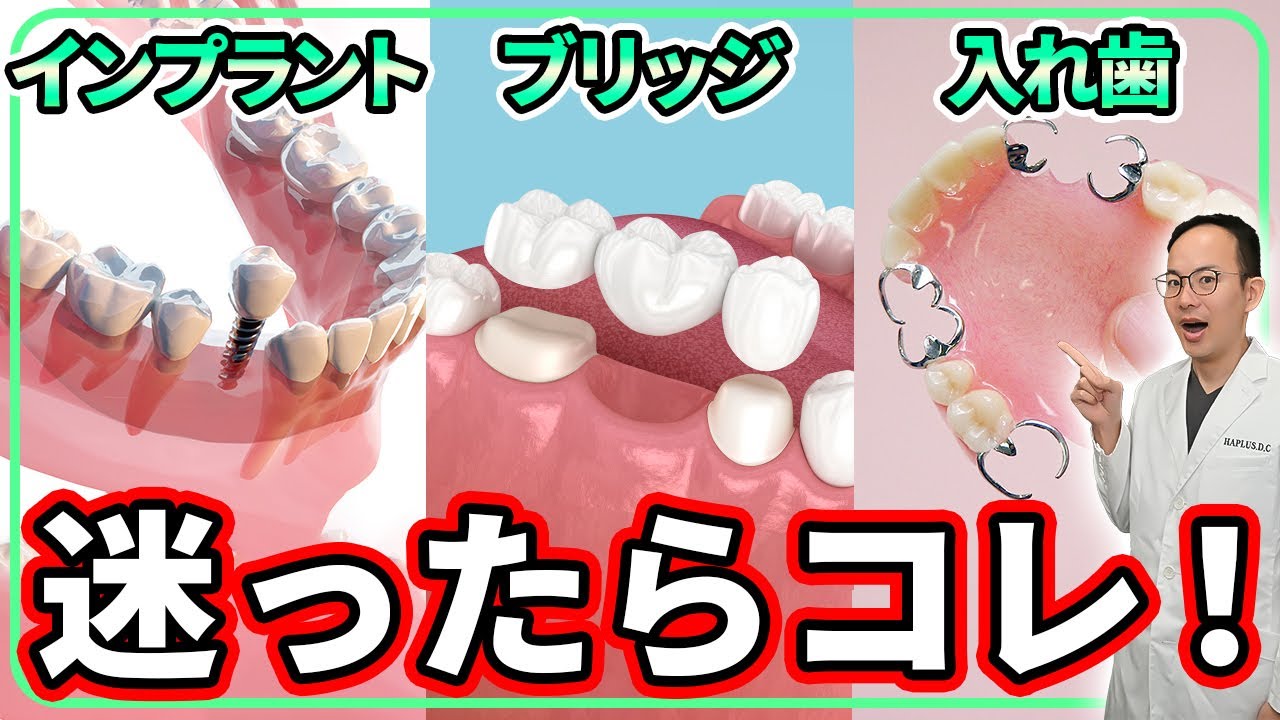 虫歯の治療！インプラント・ブリッジ・入れ歯など本当にいい詰め物・差し歯はどれなのかを歯医者が徹底解説します！
