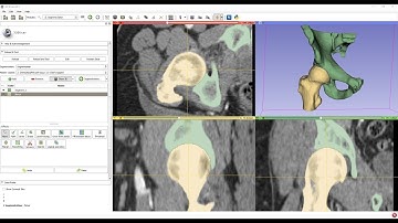 Creating femur model from CT volume using 3D Slicer