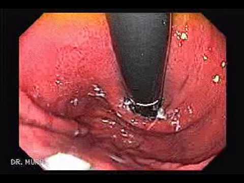 gastropatia portal hipertensiva