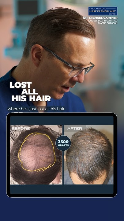 🌱Dr. Gartner Shares a Stunning Hair Transplant Transformation / 