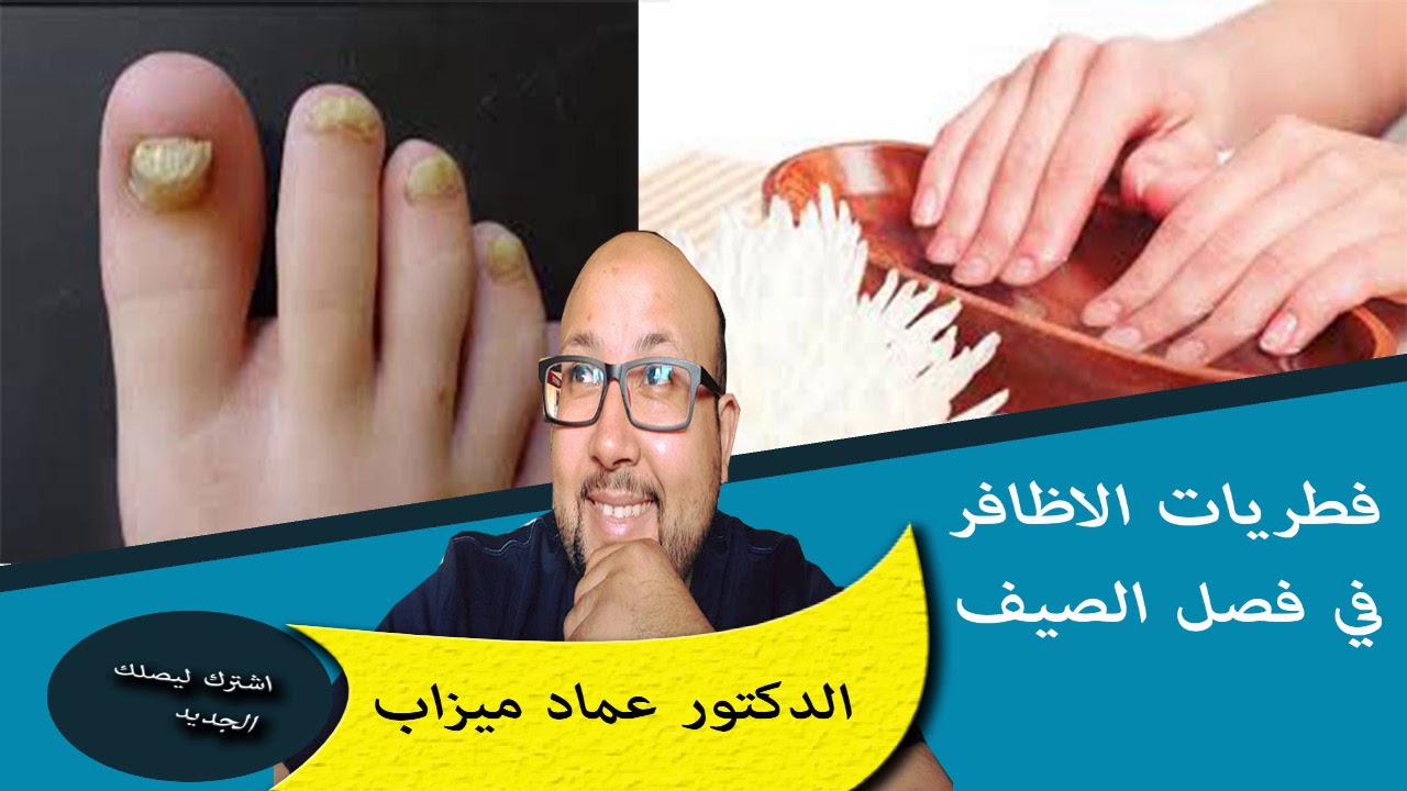 فطريات الاظافر في فصل الصيف كيفية الوقاية ووصفة طبيعية للعلاج الدكتور عماد ميزاب
