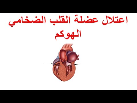 ما هو اعتلال عضلة القلب الضخامي ؟ ما هي اسباب و أعراض و مضاعفات مرض الهوكم ؟