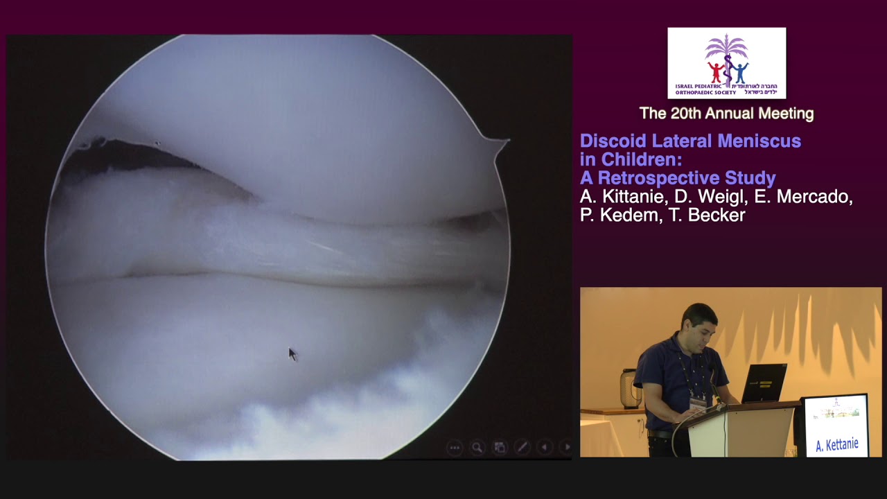 Day 2 - 16 - Discoid lateral meniscus in children: A retrospective study