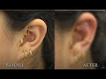 Drove  2 States Away For A Complete Ear Makeover *MUST SEE*