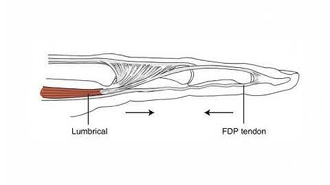 Role of Lumbricals at MCP and IP Joints   WRIST AND HAND COMPLEX