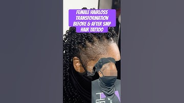 Get Your Edges Back! Permanent Alopecia HairLoss Solution For Women