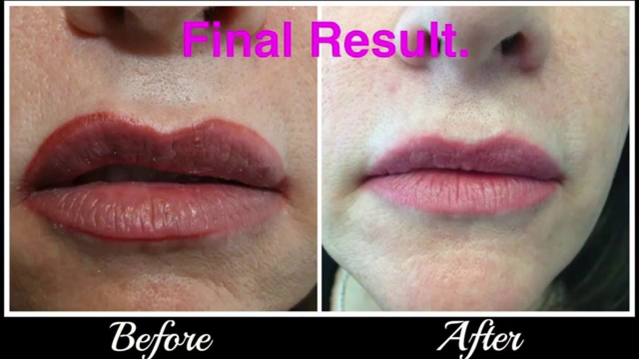 Lip tattoo Correction/Removal - YouTube