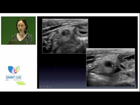 Vidéo: Ma Poussée D'endométriose A été Confondue Avec Une Appendicite