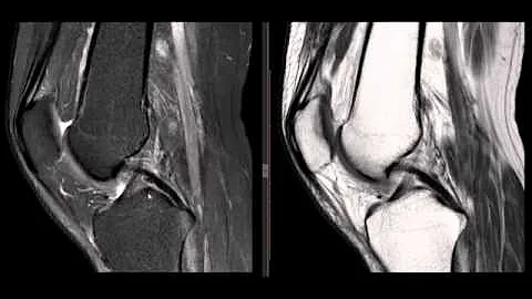 O que é joelho normal?