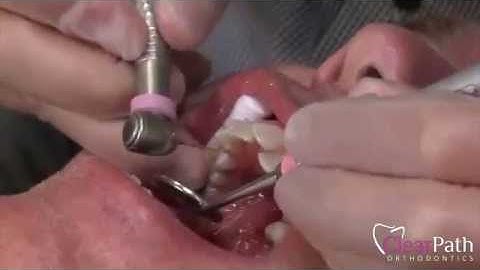 Interproximal Reduction (IPR) Procedure with Burs