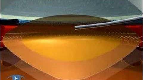 Hydrodelineation Phaco basic techniques