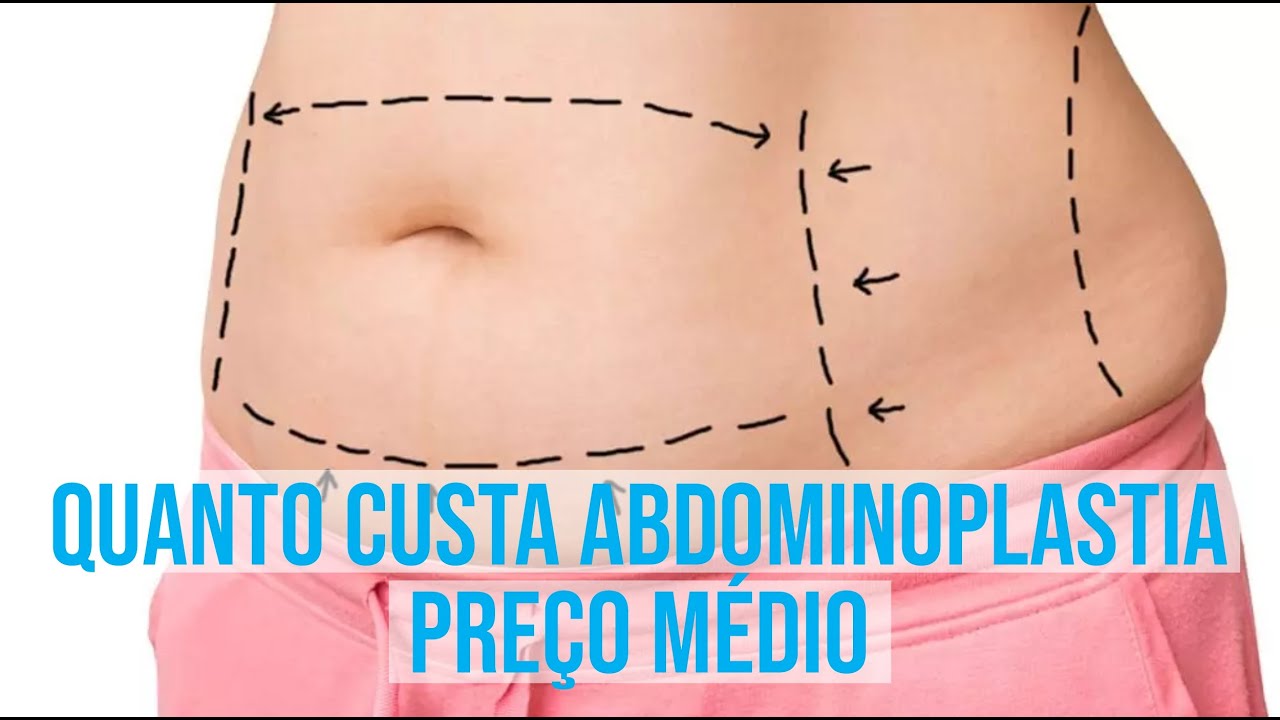 Quanto Custa a Abdominoplastia: Preço Médio - YouTube