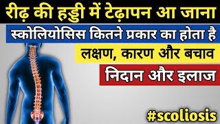 रीढ़ की हड्डी का टेढ़ापन, लक्षण, कारण, इलाज || scoliosis ko kaise thik kare || scoliosis ka ilaj