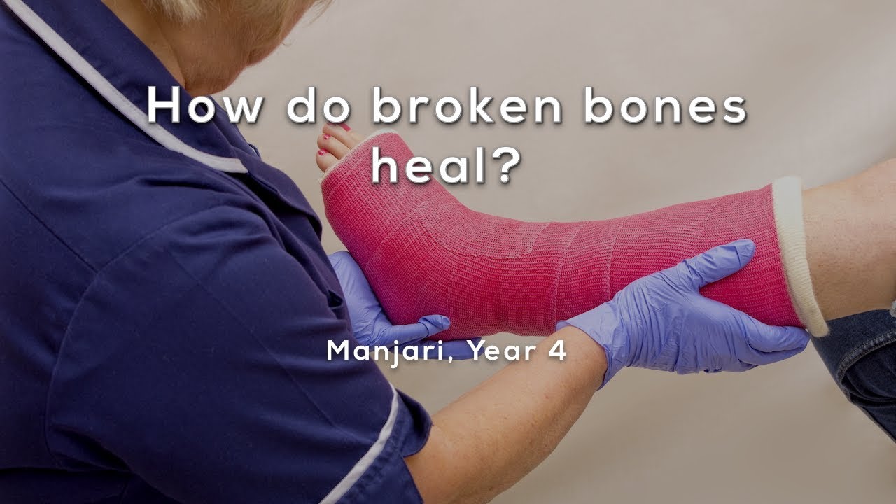 How do broken bones heal? - YouTube