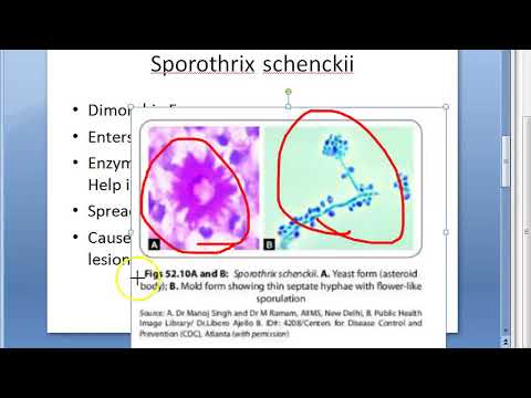 Microbiology 578 a SporoTrichosis Sporothrix schenckii Rose Gardners Asteroid body Splendore Hoeppli