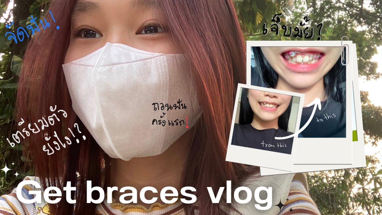 Get braces vlog : ไปจัดฟันกัน! ก่อนจัดฟันทำอะไร? เตรียมตัวยังไง? เจ็บมั้ย!? | Mely Millo