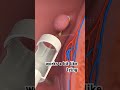 Piles rubber band surgery (3D Animation) #animation #piles #rubber #band #hemmorhoids
