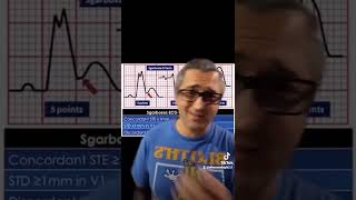 sgarbossa criteria made easy