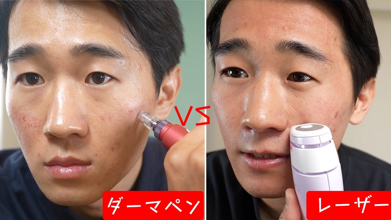 ダーマペン vsフラクショナルレーザー】美容効果が高いのはどっち