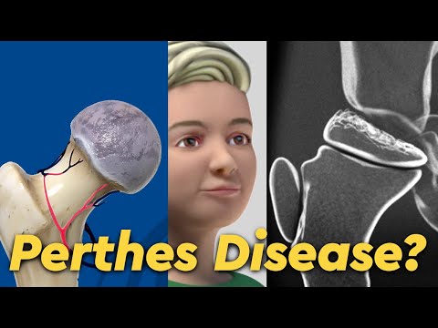 Video: Is de ziekte van Legg Calve Perthes erfelijk?