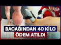 'Tedavisi Yok' Denilen Fil Hastalığına Yapay Zeka Çözümü! | Star Ana Haber