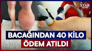 'Tedavisi Yok' Denilen Fil Hastalığına Yapay Zeka Çözümü! | Star Ana Haber
