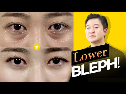 ENG]Lower Blepharoplasty - YouTube