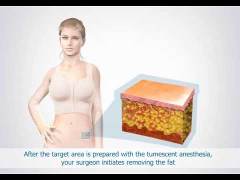 liposuction