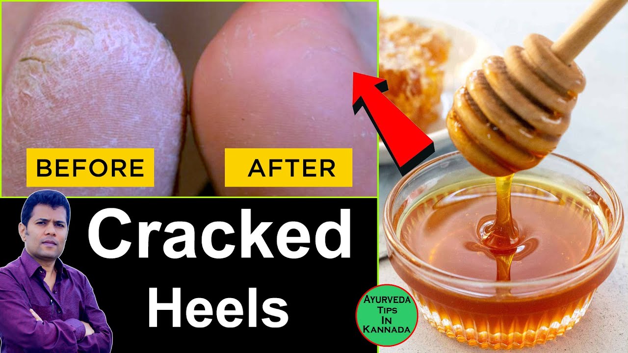 Cracked heels: Home remedies & Ayurveda Tips|Dr.Yogesh  Chavan,MD(Ayu.Kerala)|