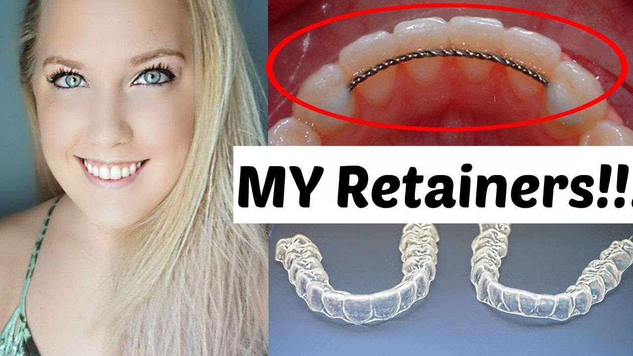 Retainers After Braces Permanent and Temporary Ashley