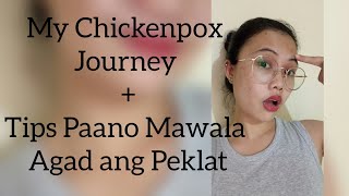 Paano Mawala Agad Ang Chickenpox at Peklat ||Anna Grimpola||